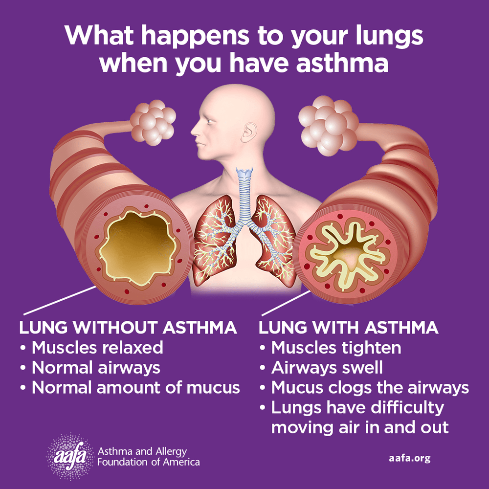 Understanding Asthma and Allergies This May