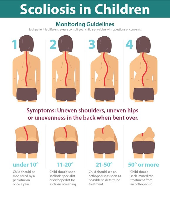 National Scoliosis Awareness Month, Exclusive Interview With A Highlander!
